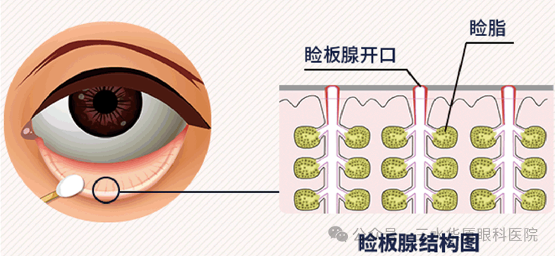 眼睑板腺