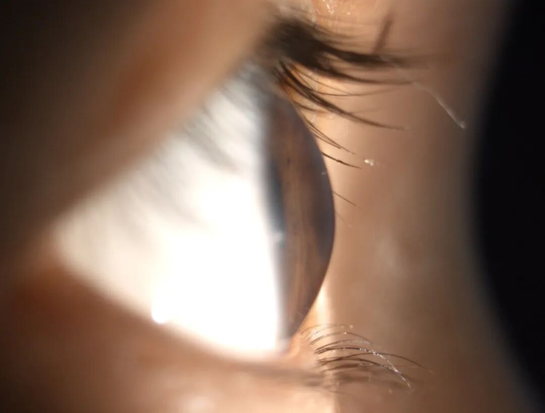 圆锥角膜患者特征