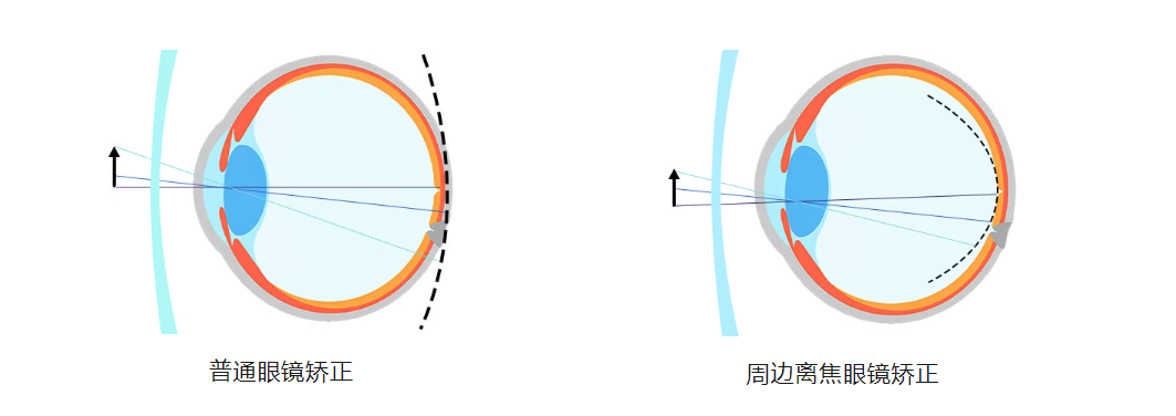 自制-离焦镜原理