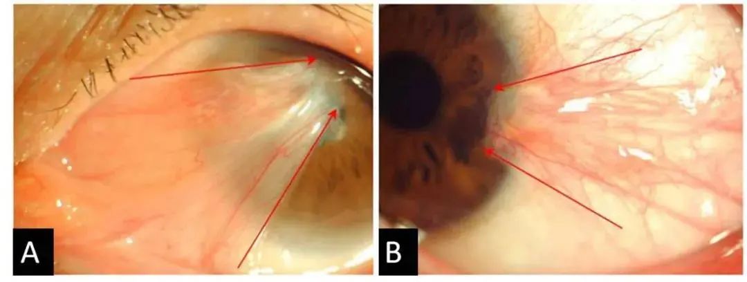 翼状胬肉临床照片