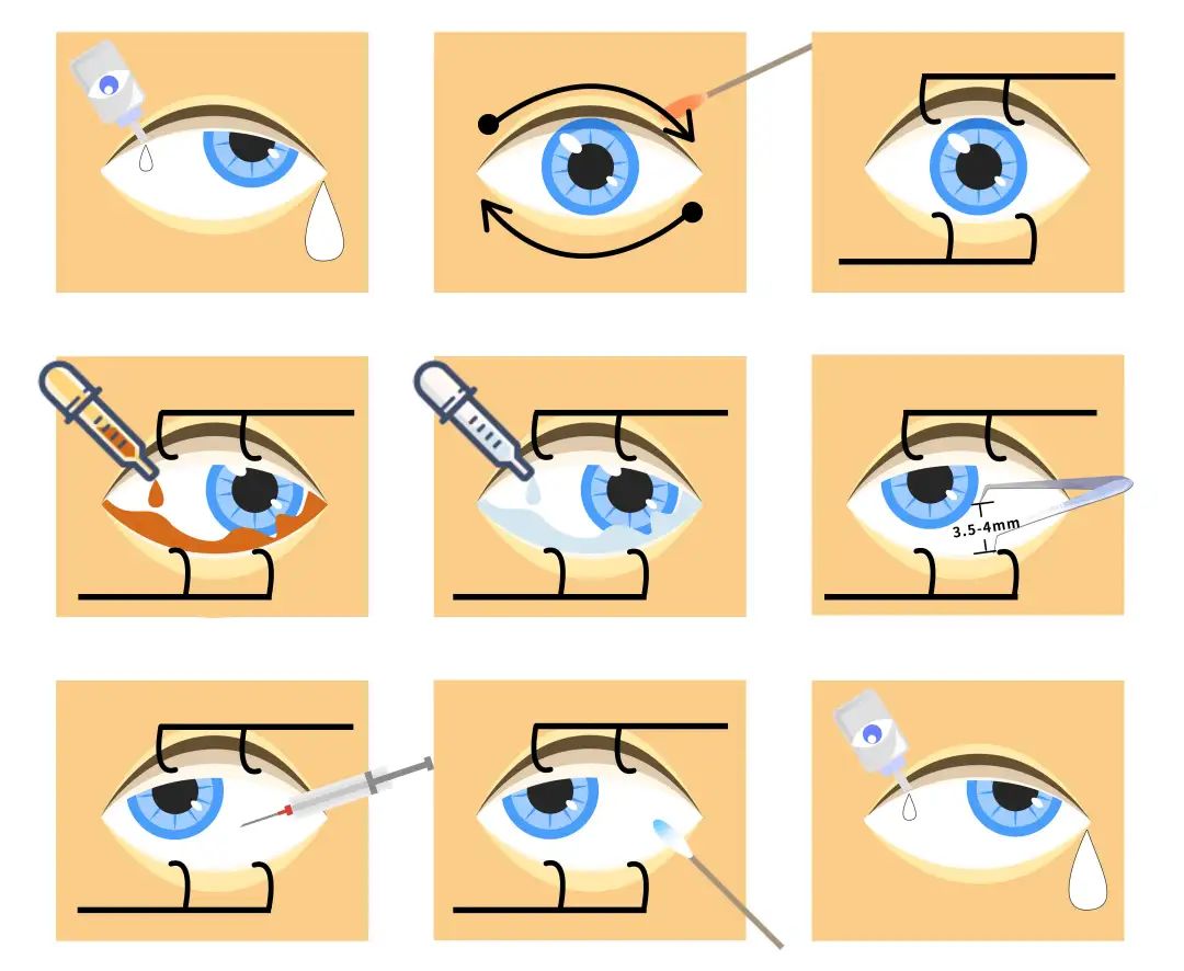 眼睛的外部治疗