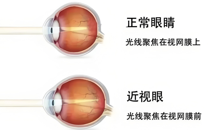 老花眼与近视眼模型