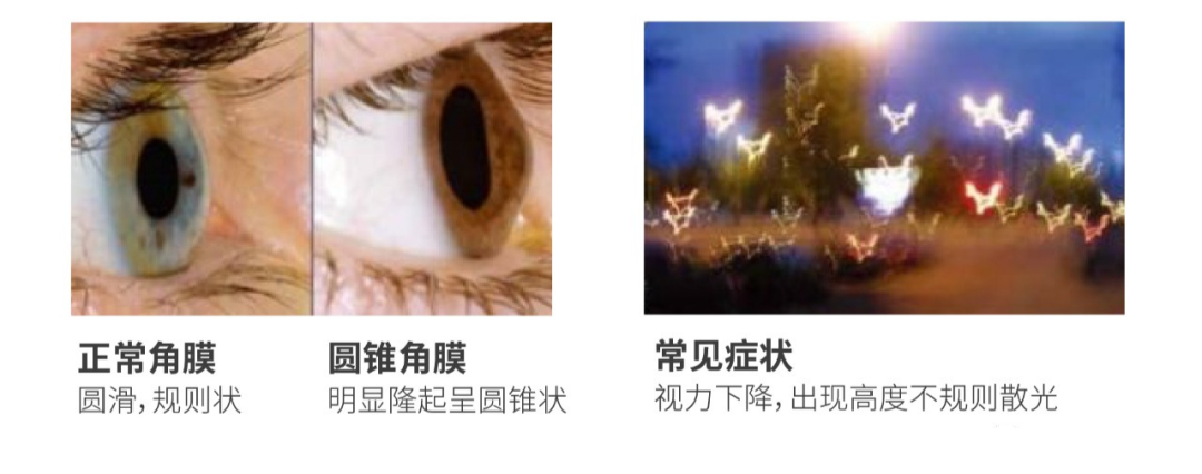 眼角膜图示