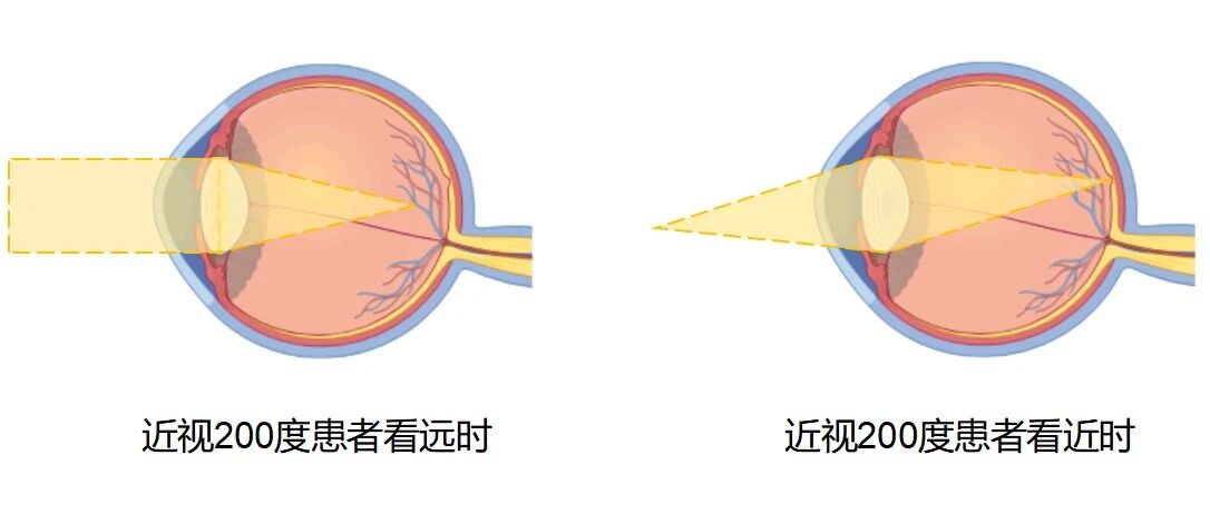 近视与老花同时存在