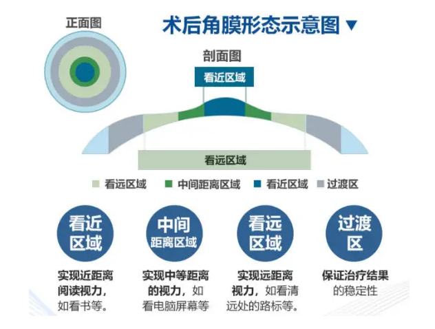 术后角膜心态示意图