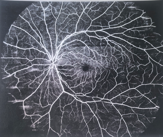 视网膜动脉阻塞