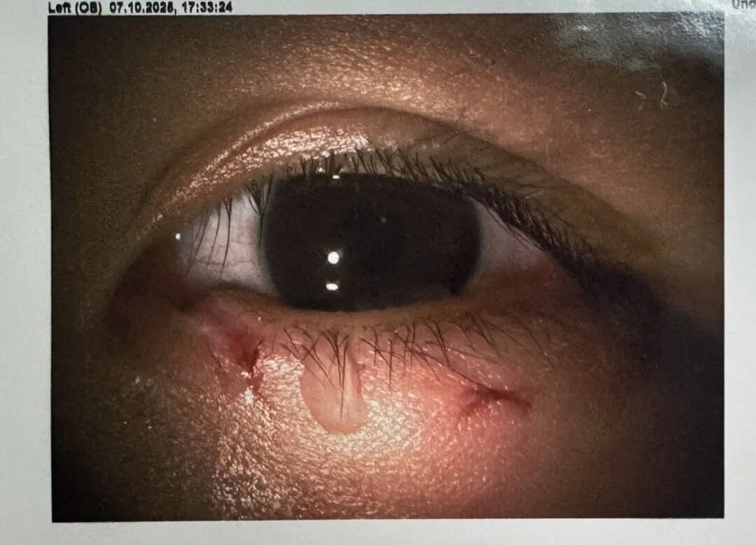 六岁孩童眼部撞击后,导致左眼上、下泪小管断裂