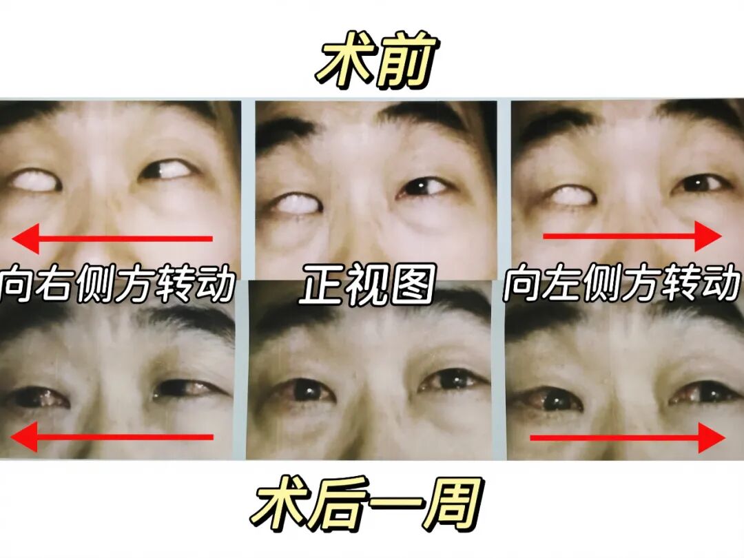 术前术后对比图