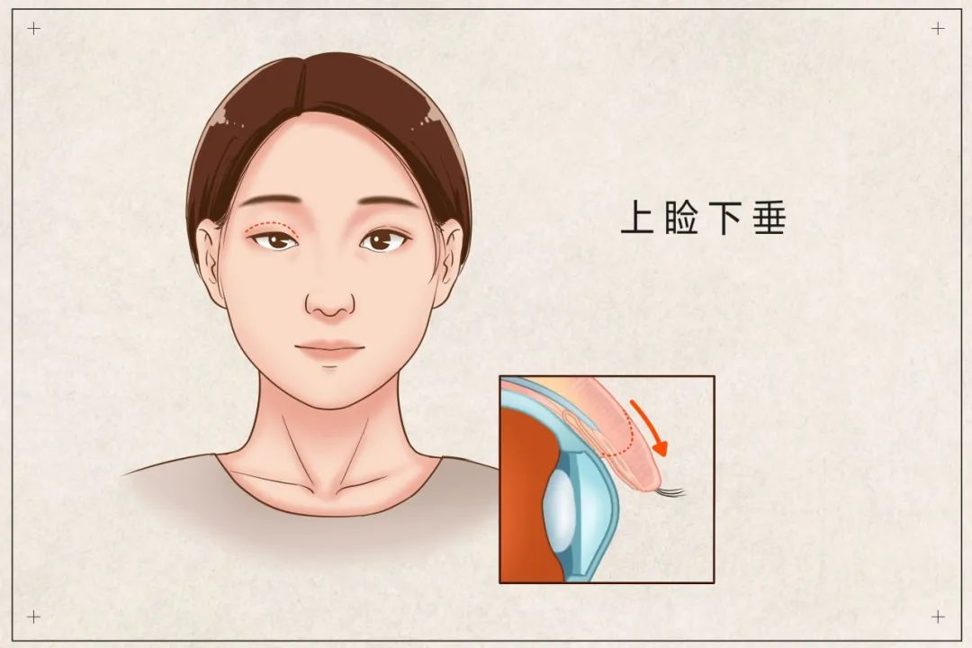 上海和平眼科|眼睛一边大一边小怎么回事？有可能是这个原因导致！