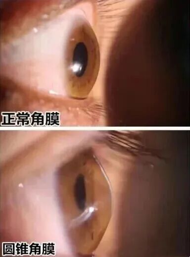 圆锥角膜