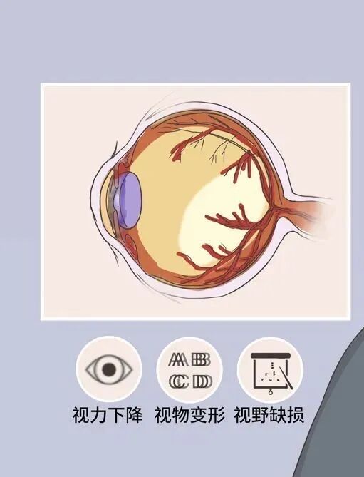 视网膜缺血、缺氧