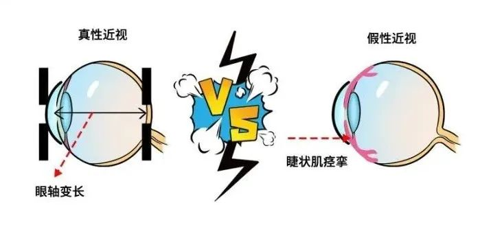 真假近视判断