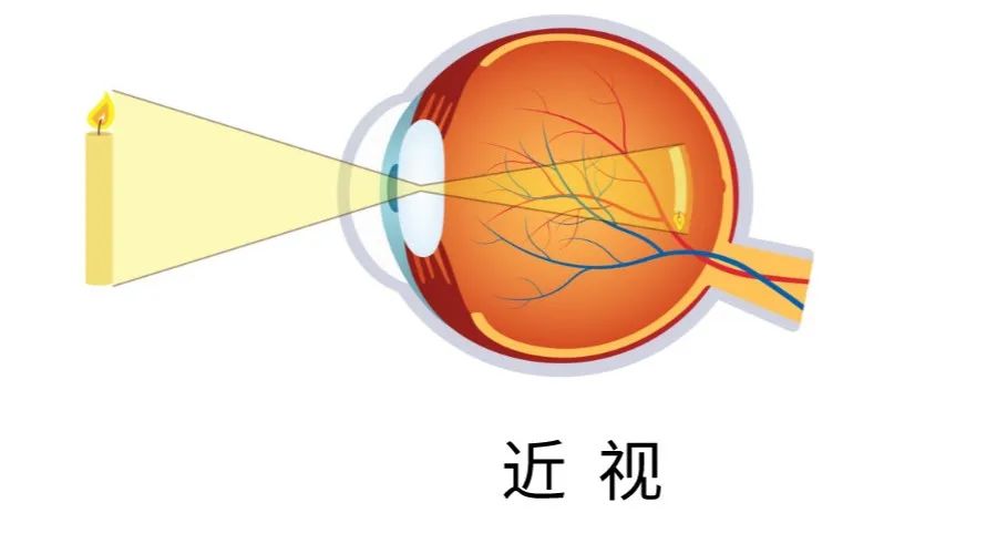 近视
