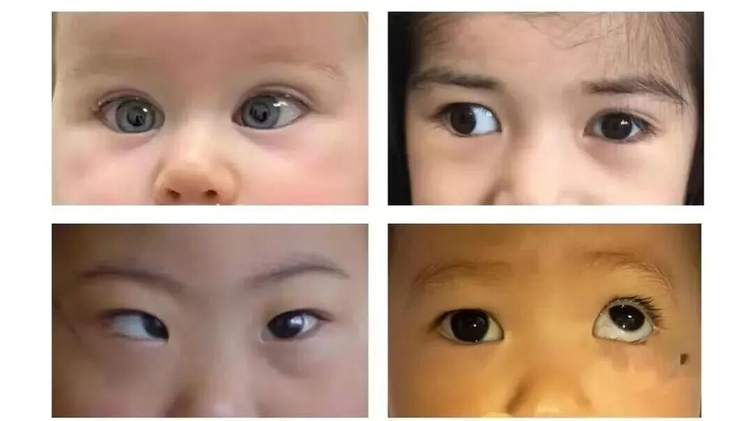 上海和平眼科|【收藏】关于孩子斜视的常见疑问，家长们都应该了解，建议收藏！