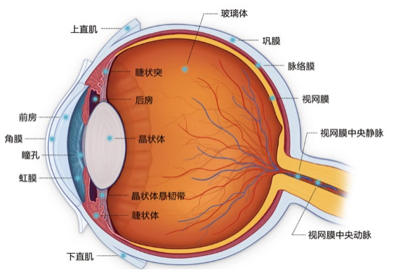 眼球白内障示意图
