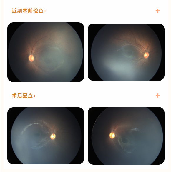 早产儿眼睛诊察