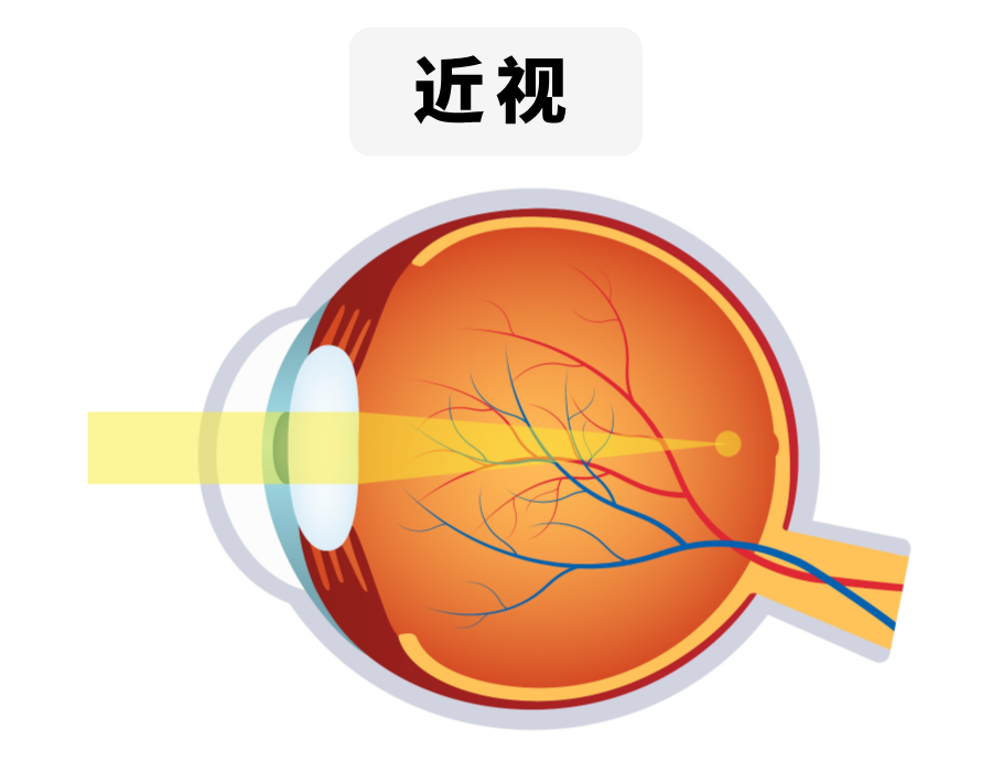 近视彩色插图