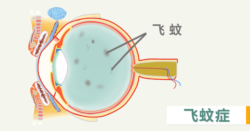 飞蚊症