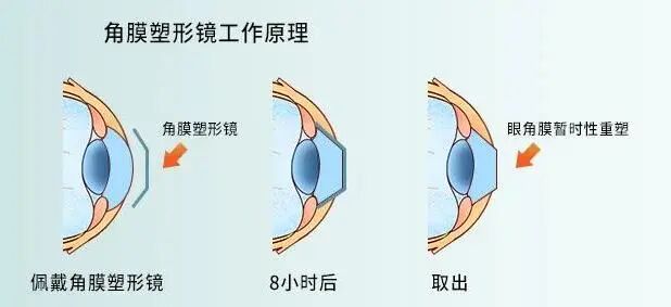 角膜塑形镜工作原理