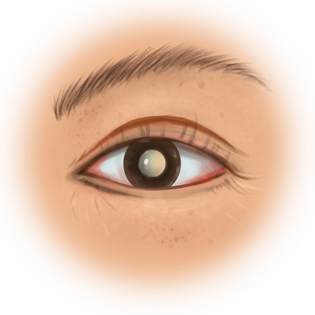 眼睛局部
