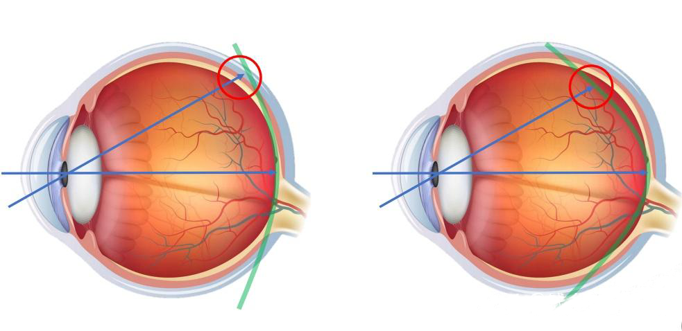 普通眼镜和离焦眼镜