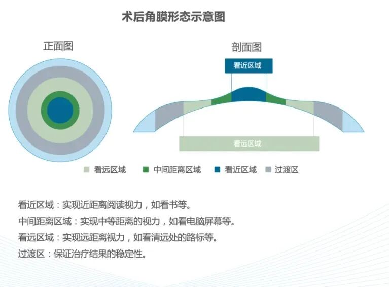 术后角膜剖面