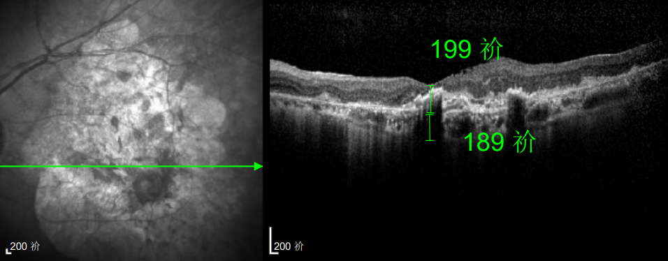 △规划化治疗后的左眼